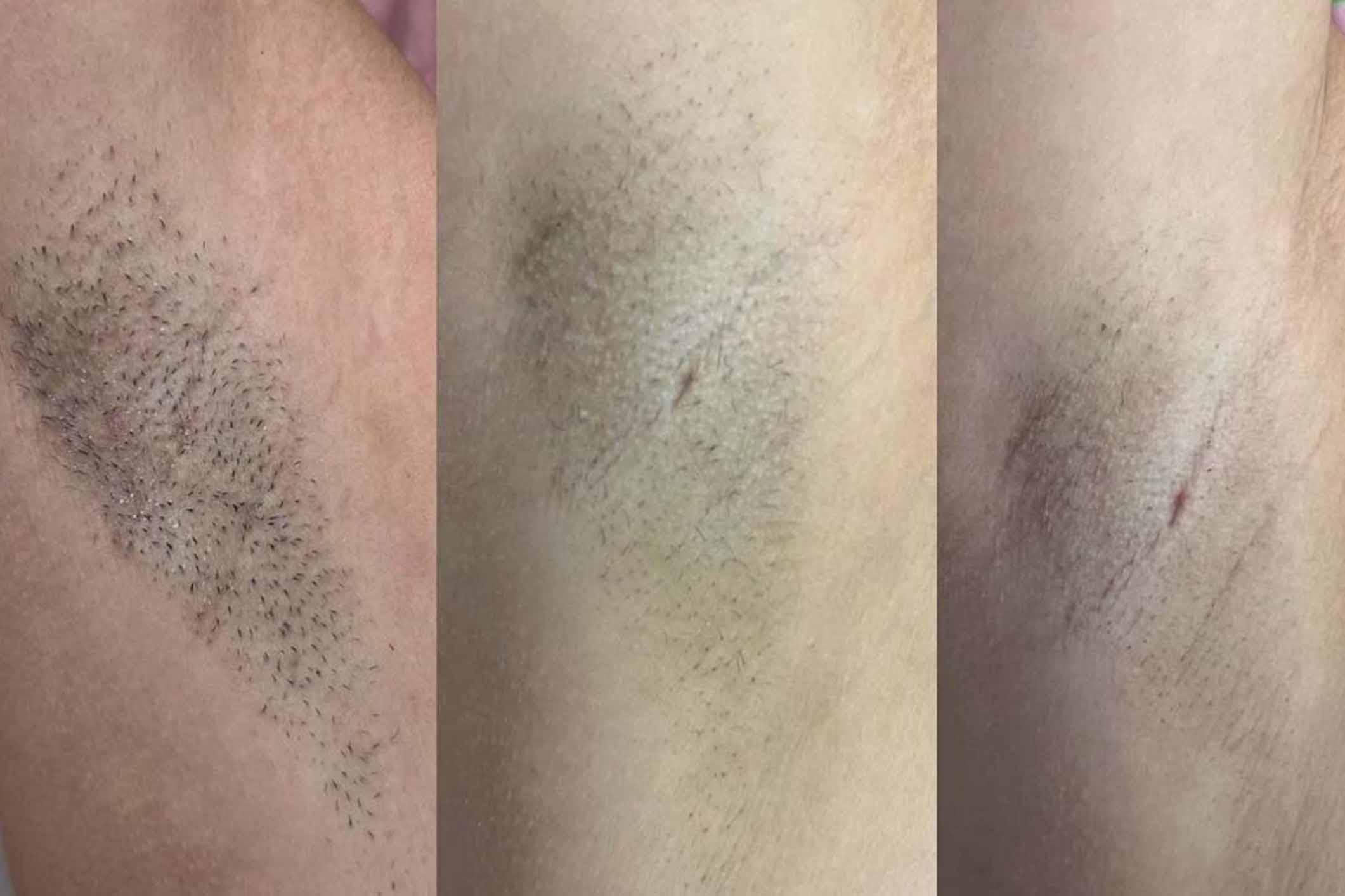 Laser Hair Removal Crown Point, IN | Med Spa in Randolph, image size:2121x1414